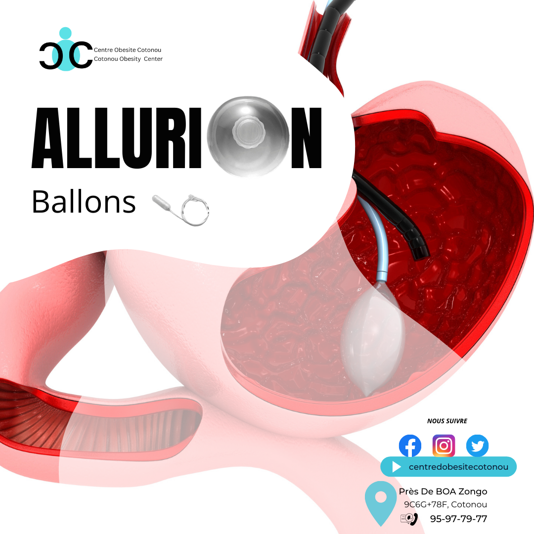 L’Allurion Gastric Weight Loss Balloon